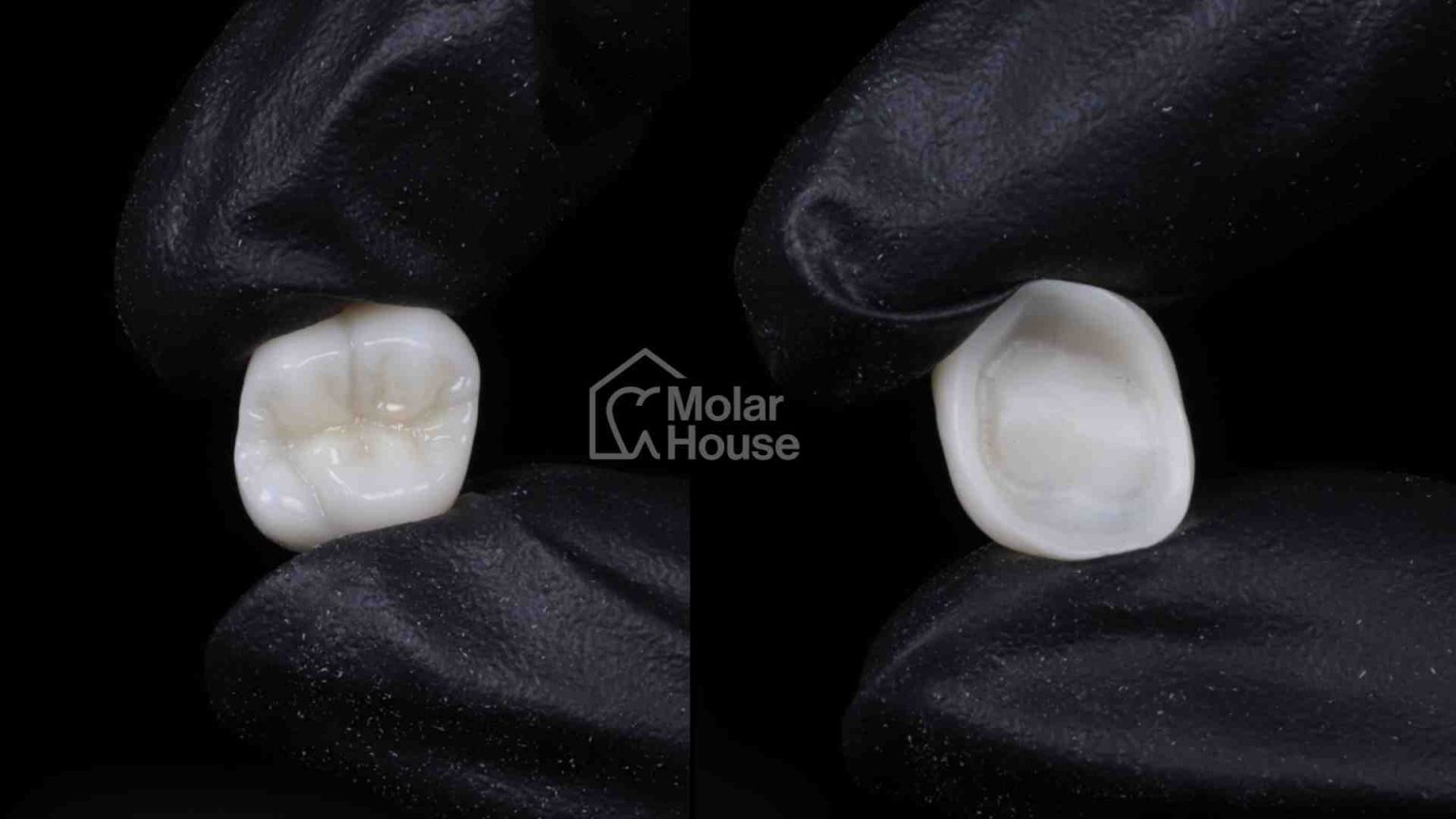 Zirconia VS Porcelain Fused to Metal Crowns Molar House