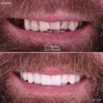 Carillas e implantes dentales