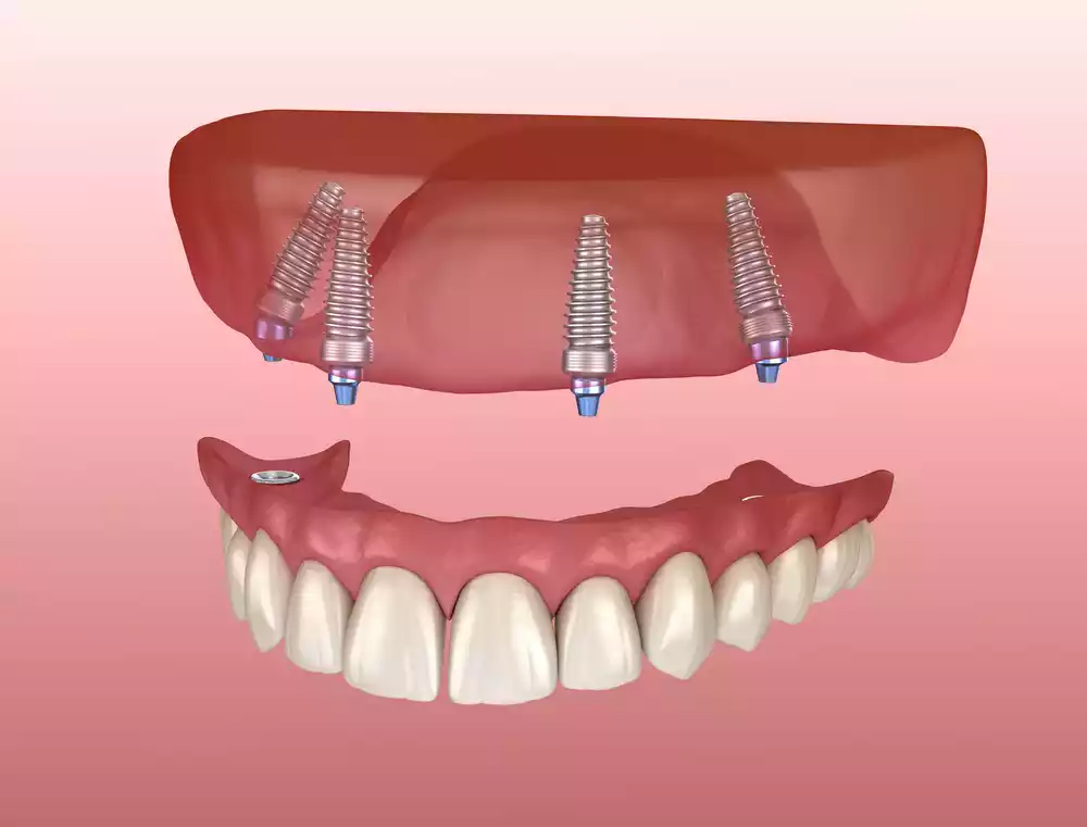 All-on-4 Implants