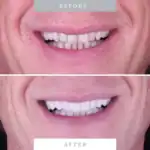 Veneer dental transformation for brighter, aligned teeth.