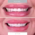 Close-up of before and after teeth whitening for a stunning smile.
