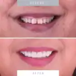 Close-up of improved, whiter, straighter teeth after dental cosmetic procedures.