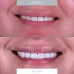 Close-up of a beautiful, bright smile with dental veneers, showcasing perfect, white teeth for improved aesthetics.