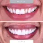 Bright white, healthy teeth after professional dental whitening and cosmetic procedures.