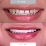 Close-up of a person's before and after teeth whitening and dental veneer application.