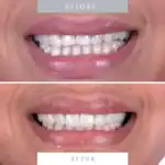Close-up of a bright, whiter smile after dental treatment at Molar House.