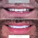 Close-up of man's smile before and after dental veneers, showing improved teeth appearance.