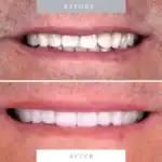 Close-up of before and after teeth whitening and cosmetic dental treatment showing improved smile.