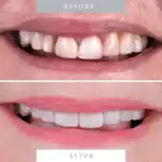 Close-up of improved teeth with veneers and whitening treatment.