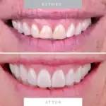 Cosmetic dental repair, before and after teeth whitening, Molar House, smiling teeth transformation, dental aesthetic improvement, smile makeover.