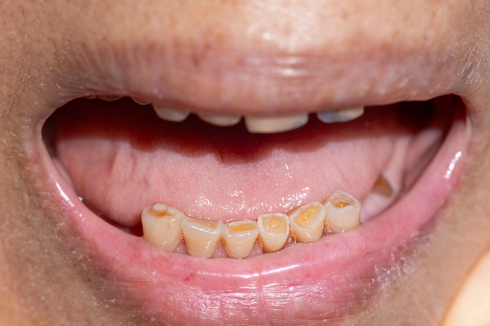 stress and teeth grinding