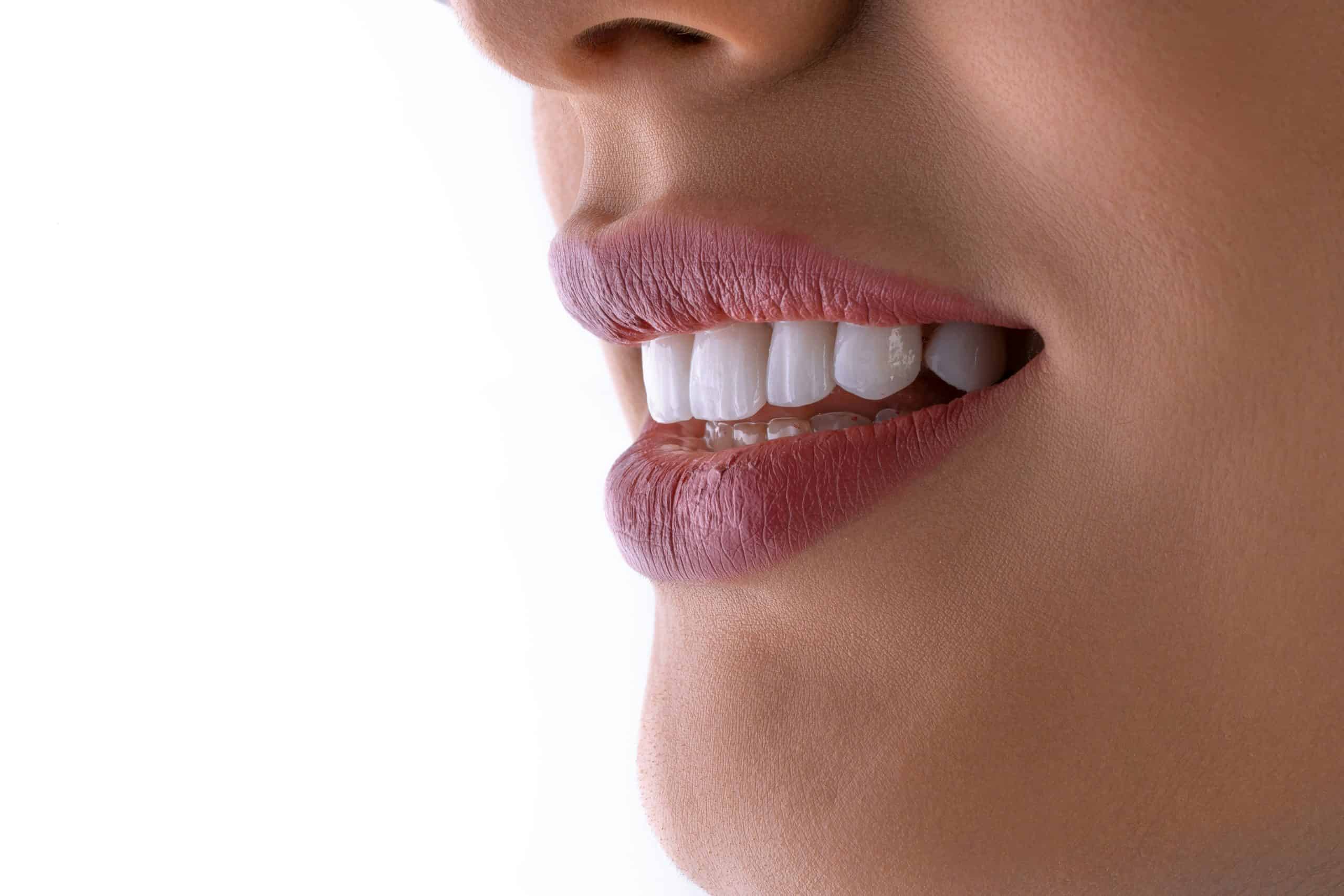teeth whitening