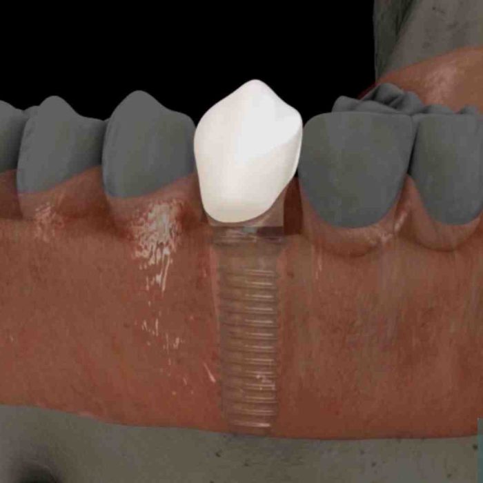 Dental Implants in Tijuana