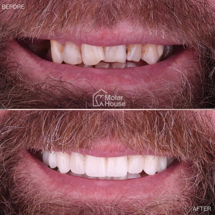 Carillas e implantes dentales