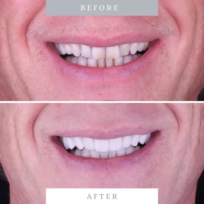 Veneer dental transformation for brighter, aligned teeth.