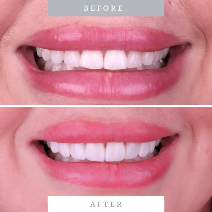 Caso 10 antes y despues