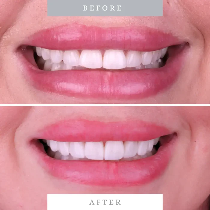 Close-up of before and after teeth whitening for a stunning smile.
