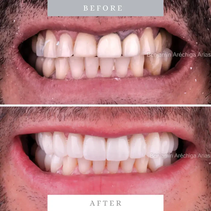 Close-up of a man's smile showing before and after teeth whitening and cosmetic dental improvements.