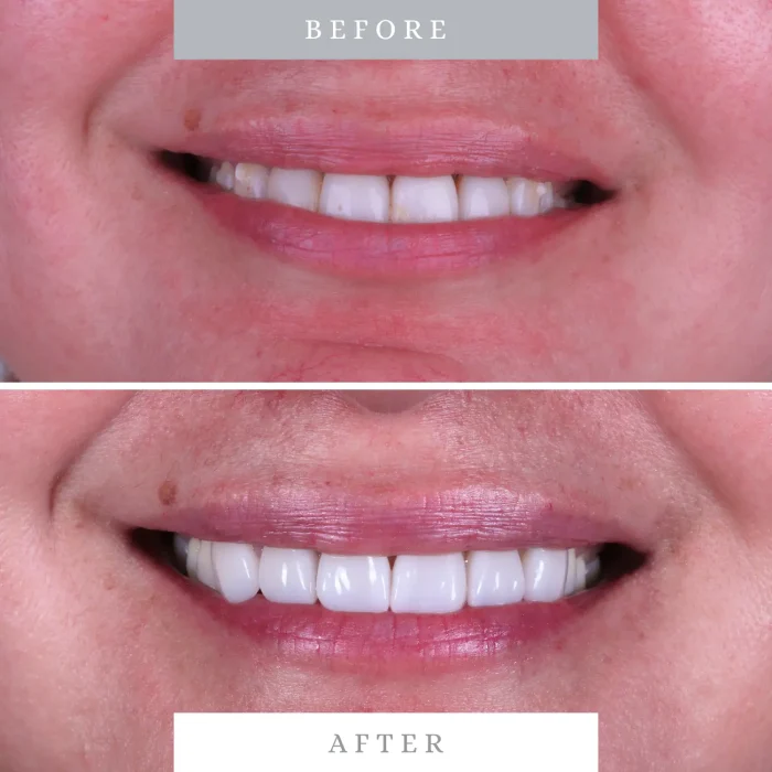 Caso 2 antes y despues