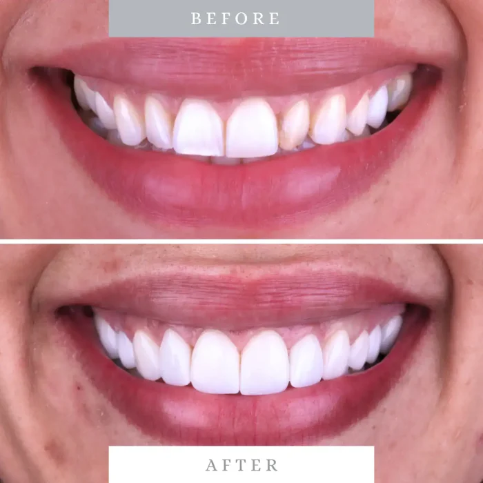 Bright white, healthy teeth after professional dental whitening and cosmetic procedures.