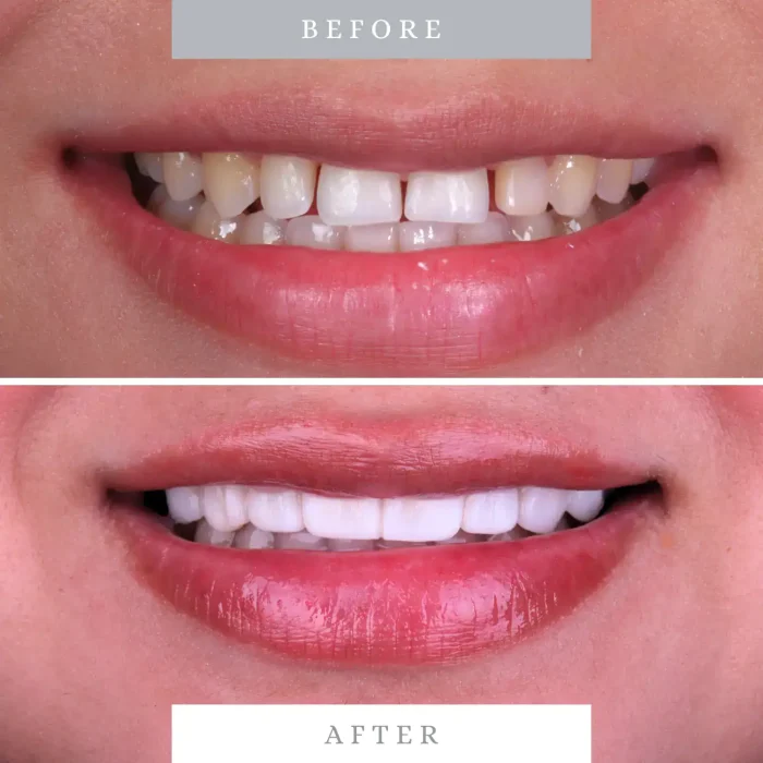 Close-up of a person's before and after teeth whitening and dental veneer application.