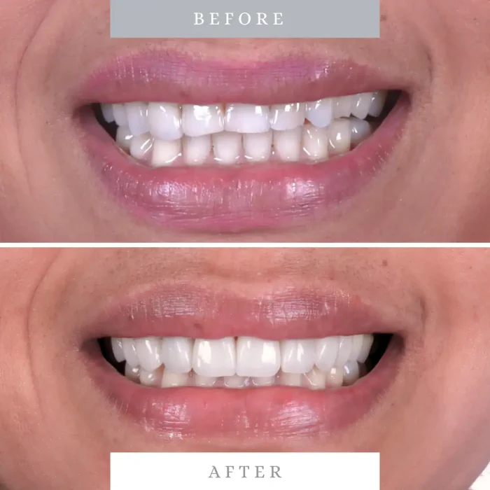 Close-up of a bright, whiter smile after dental treatment at Molar House.