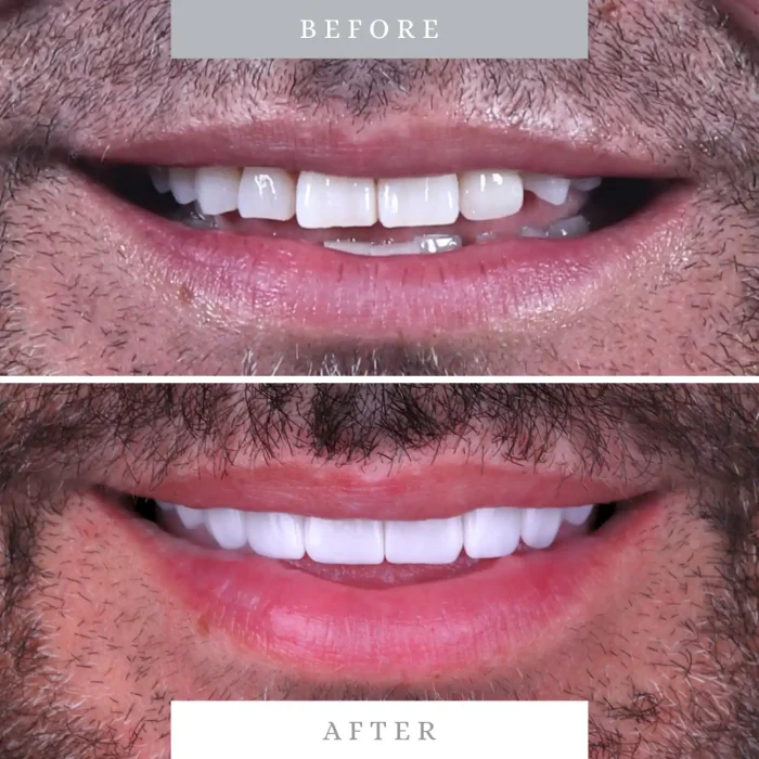 Caso 6 antes y despues