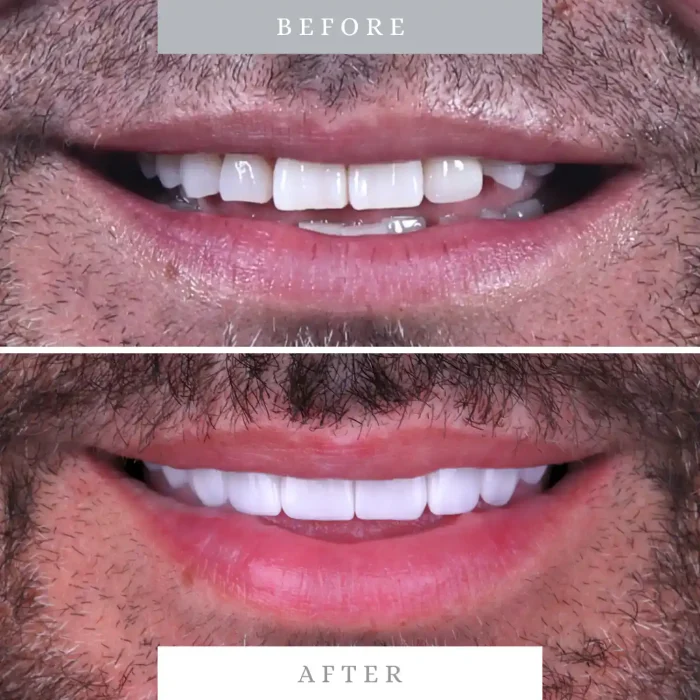 Close-up of man's smile before and after dental veneers, showing improved teeth appearance.