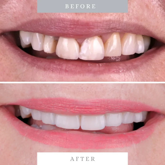 Caso 8 antes y despues