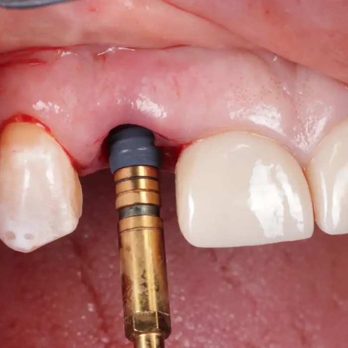 Dental Implants