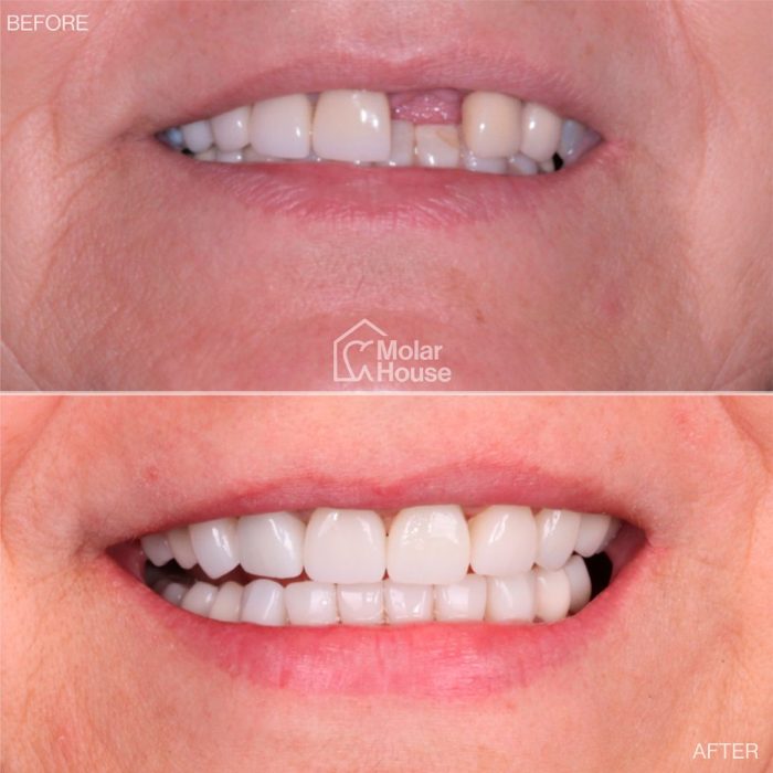 Rehabilitación completa, cambio de coronas e Implante dental.