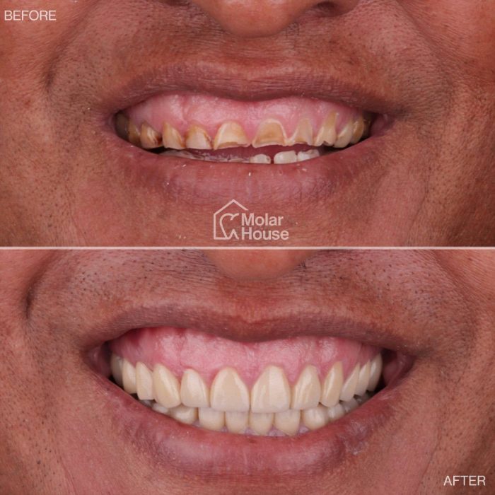 Rehabilitación completa con coronas de zirconia