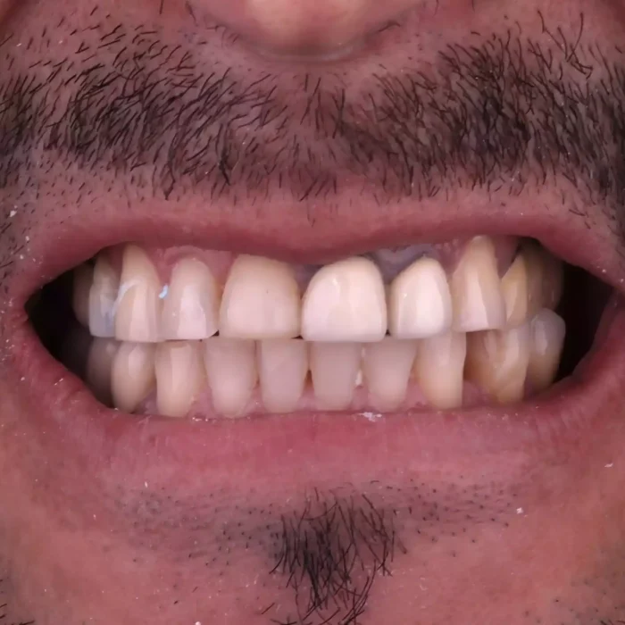 Veneers (23)