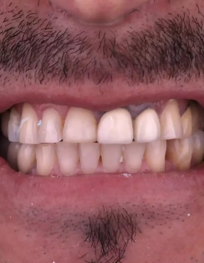 Veneers (23)