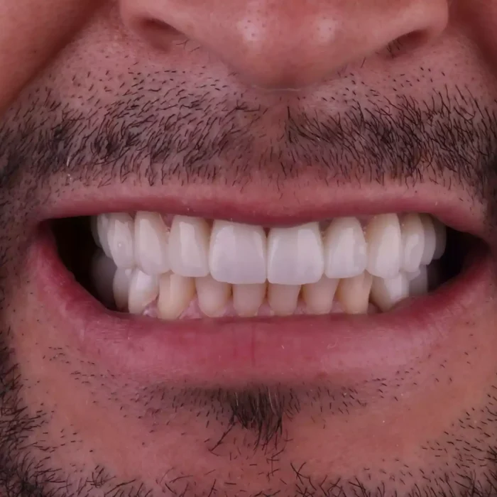 Veneers (24)