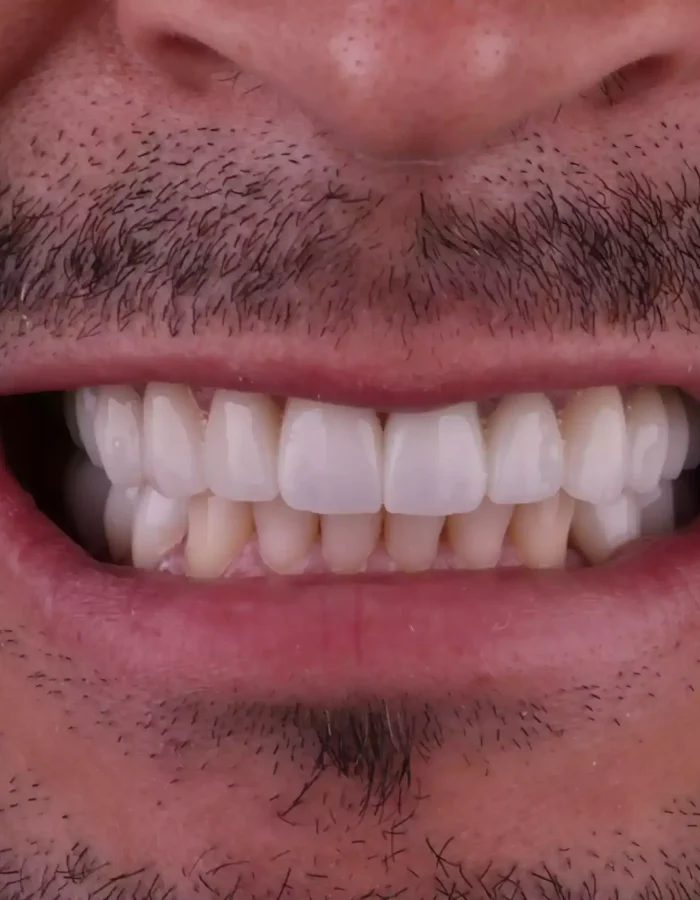 Veneers (24)