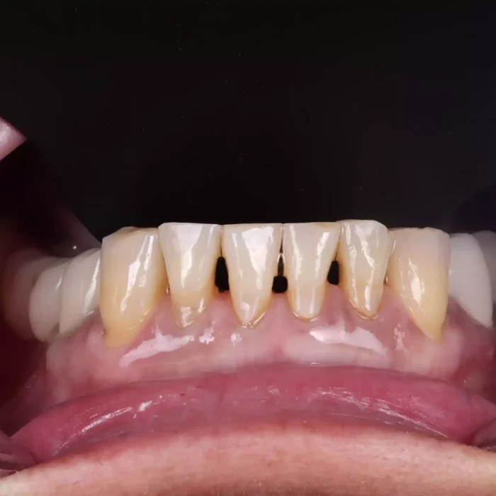 Veneers (27)