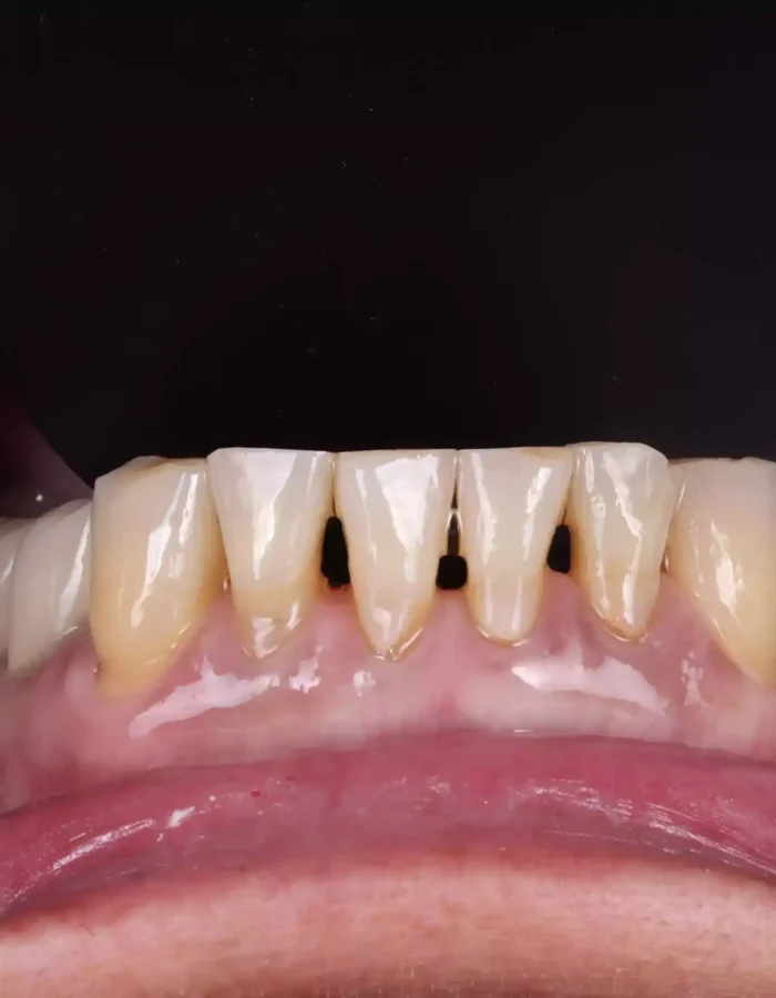Veneers (27)