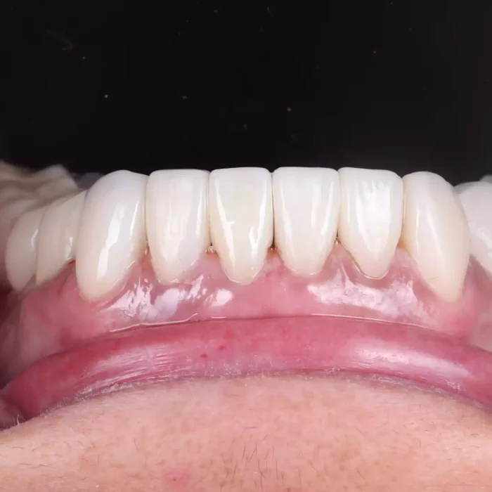 Veneers (28)