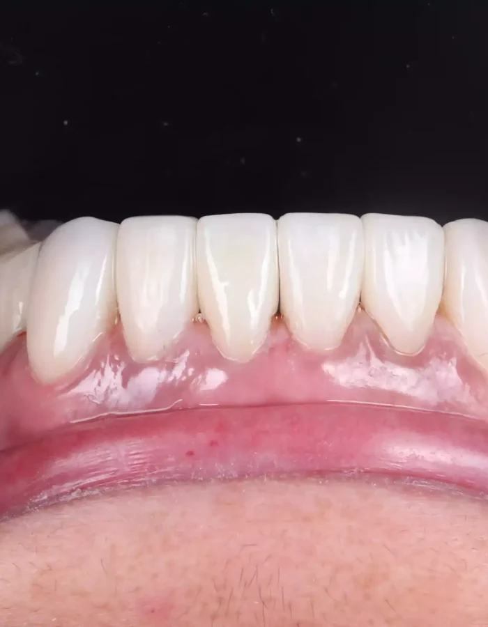 Veneers (28)