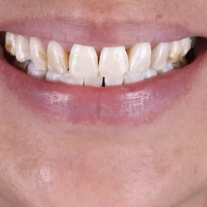 Veneers (29)