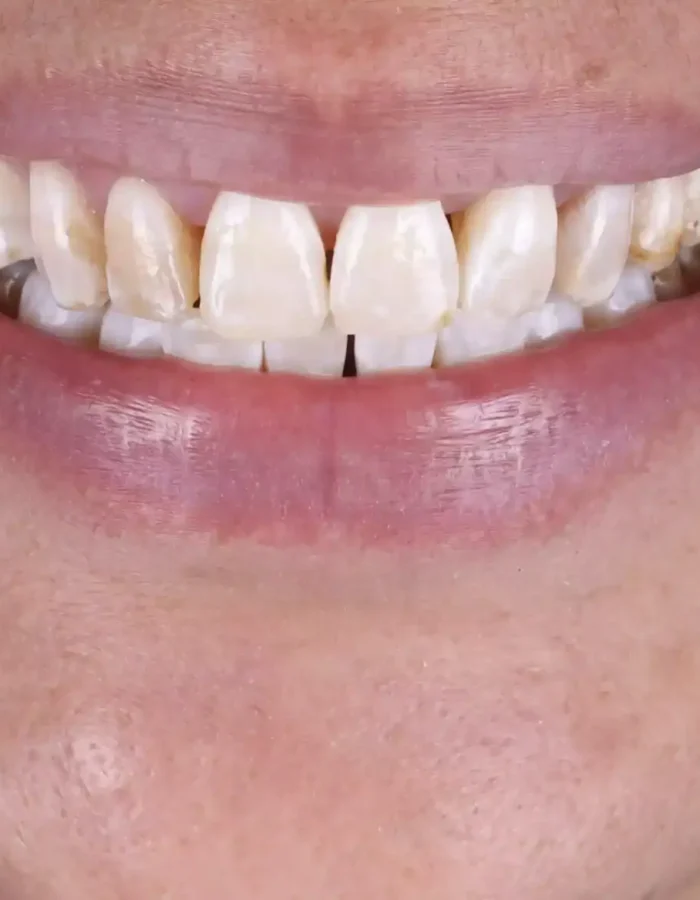 Veneers (29)