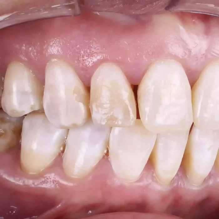Veneers (3)