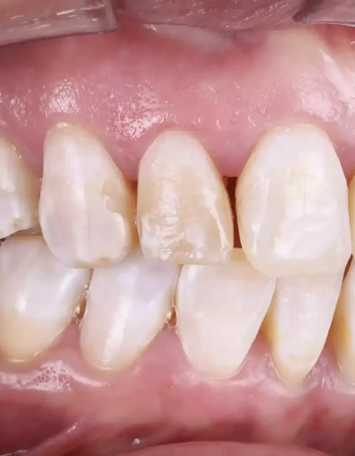 Veneers (3)