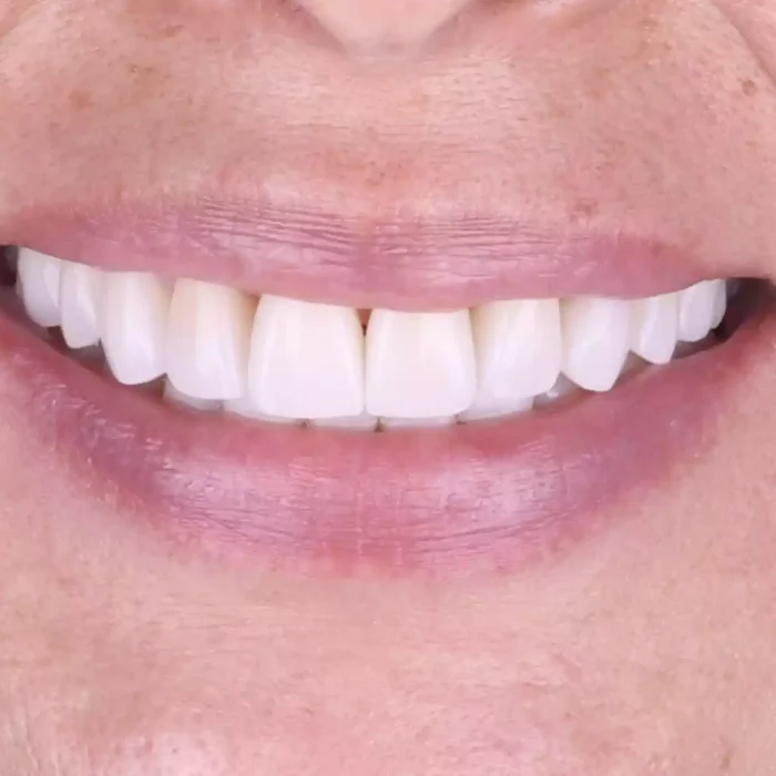 Veneers (30)