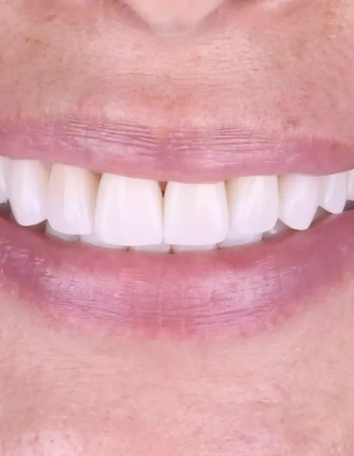 Veneers (30)