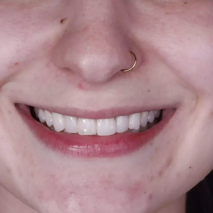 Veneers (31)