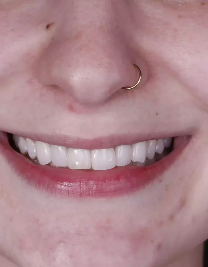 Veneers (31)