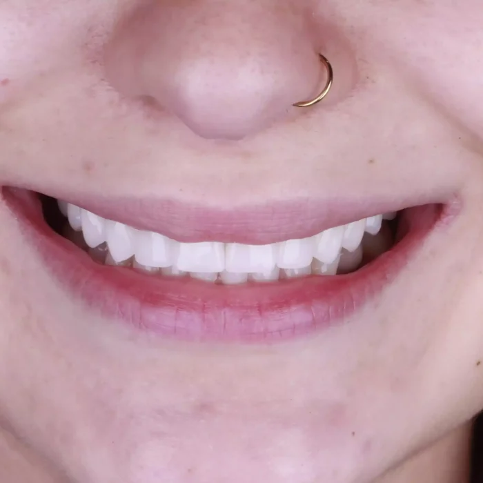 Veneers (32)
