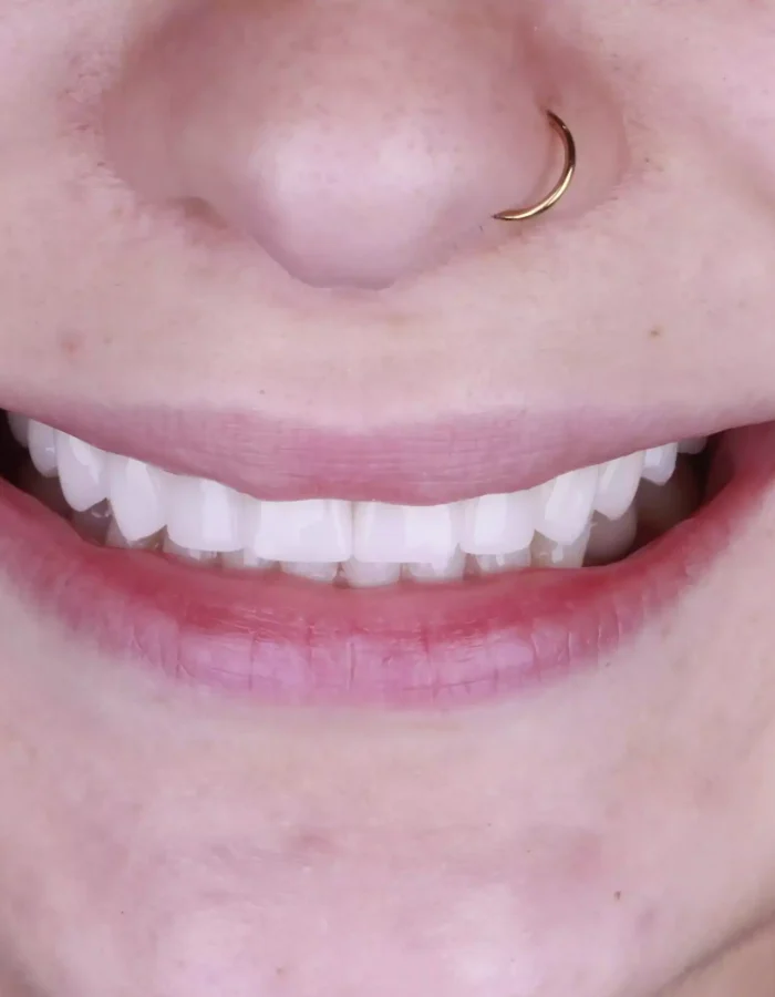 Veneers (32)